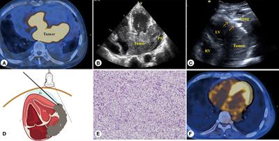 Percutaneous ultrasound-guided core needle biopsy for the diagnosis of cardiac tumors: Optimizing the treatment strategy for patients with intermural and pericardial cardiac tumors